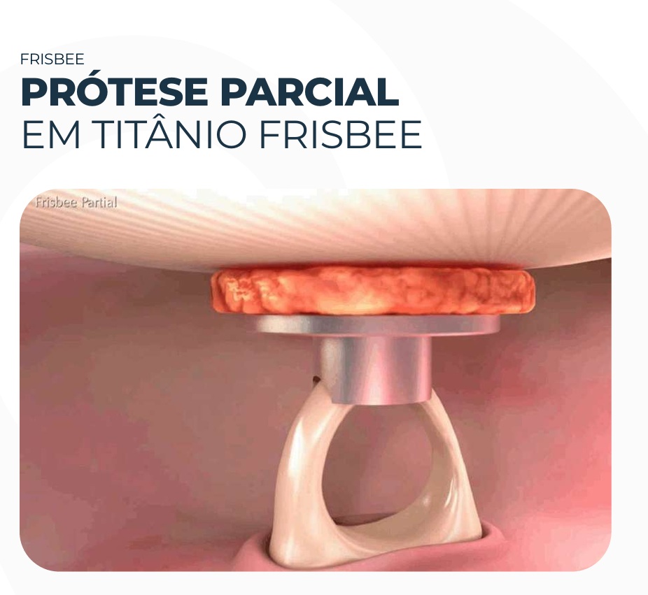 Prótese parcial em titânio Frisbee